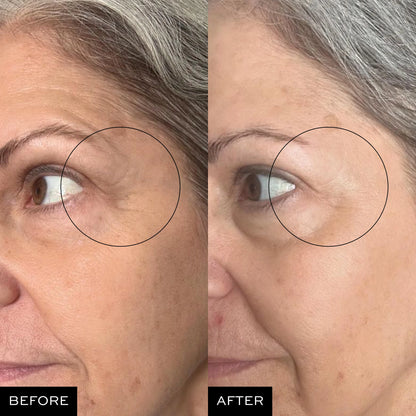 Before and after comparison of skin texture around eye area, showing reduced fine lines and wrinkles.